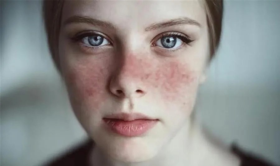 Tratamento de Lúpus Eritematoso Sistêmico Juvenil